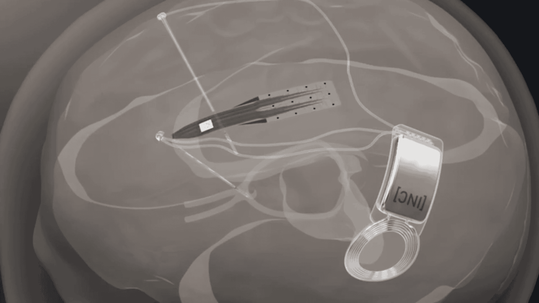 /images/INBRAIN-Microsoft-Partner-to-Develop-AI-Powered-Brain-Interface-Tech.png